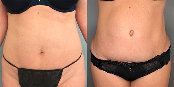 Tummy Tuck 111 Harley St.