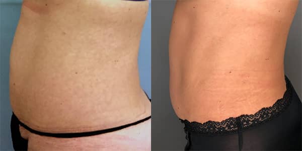 Tummy Tuck 111 Harley St.