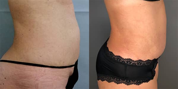 Tummy Tuck 111 Harley St.