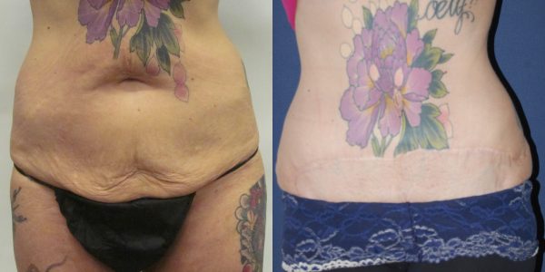 Tummy Tuck Before & After