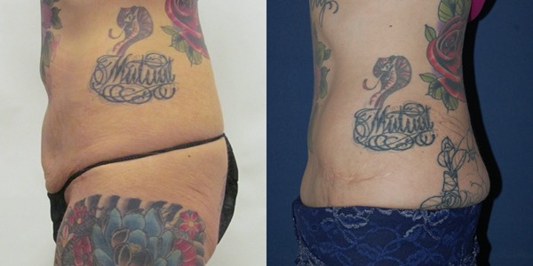 Tummy Tuck Before & After