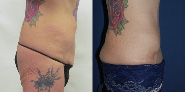 Tummy Tuck Before & After