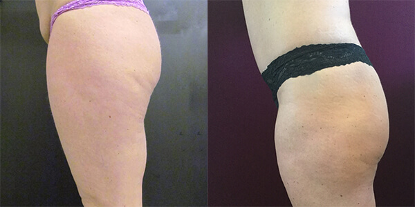 Tummy Tuck 111 Harley St.