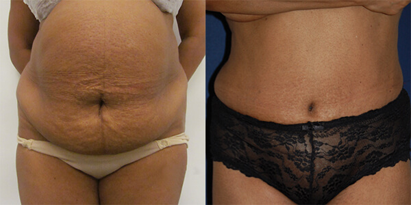 Tummy Tuck 111 Harley St.