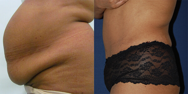 Tummy Tuck 111 Harley St.