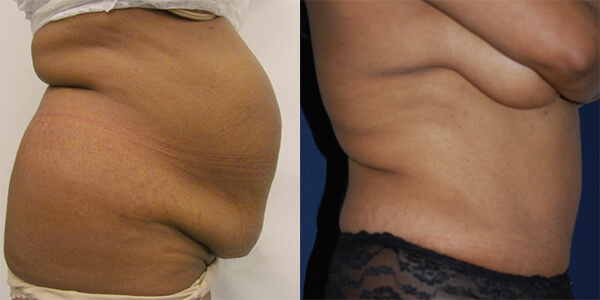 Tummy Tuck 111 Harley St.