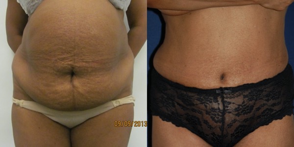 Tummy Tuck Before & After