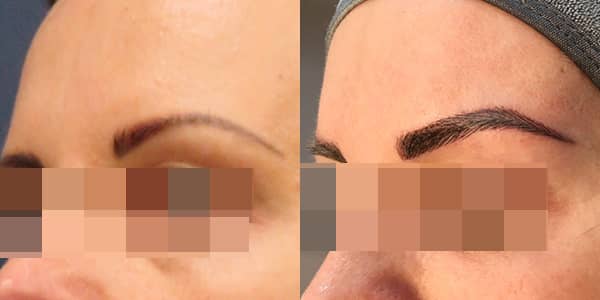 London Cosmetic Tattooing - Eye Brow