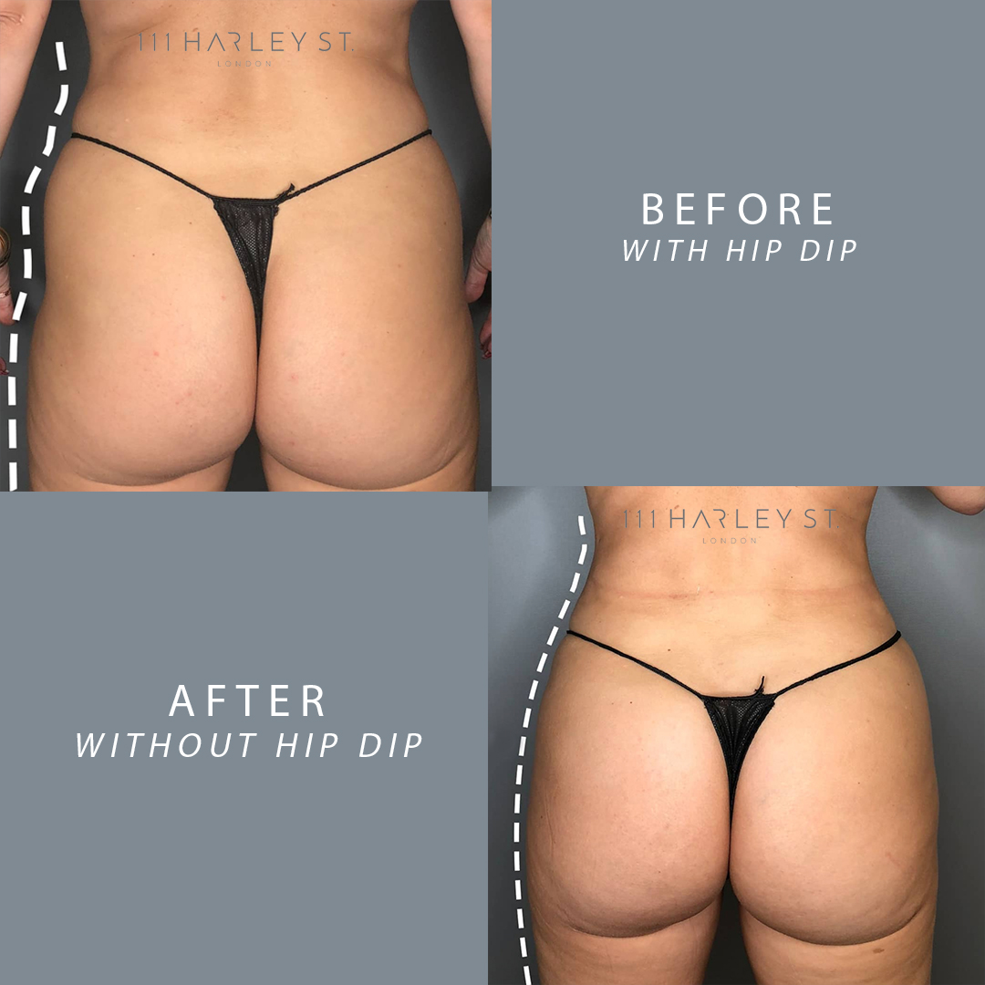 Before and After Hip Dips. Before and After Hip Dips