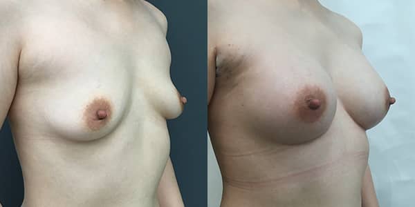Breast Enlargement London Plastic Surgery