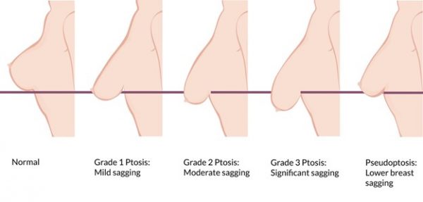 Understanding Breast Ptosis & Breast Lift Options - 111 Harley St. London