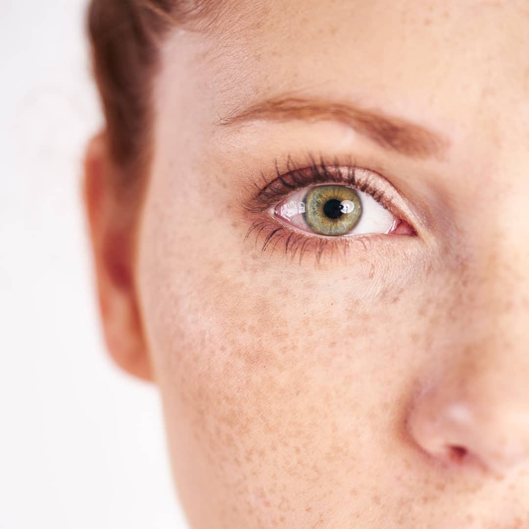 What is Cosmelan Peel Involve