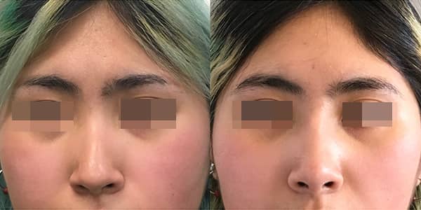 Asian Rhinoplasty