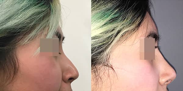 Asian Rhinoplasty