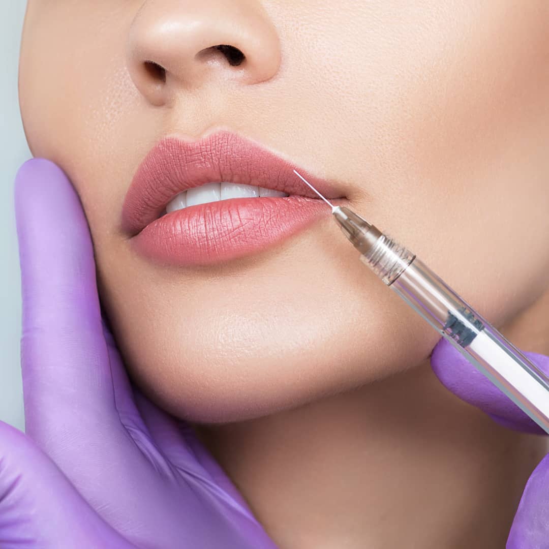 Lip-Lift-or-Lip-Filler