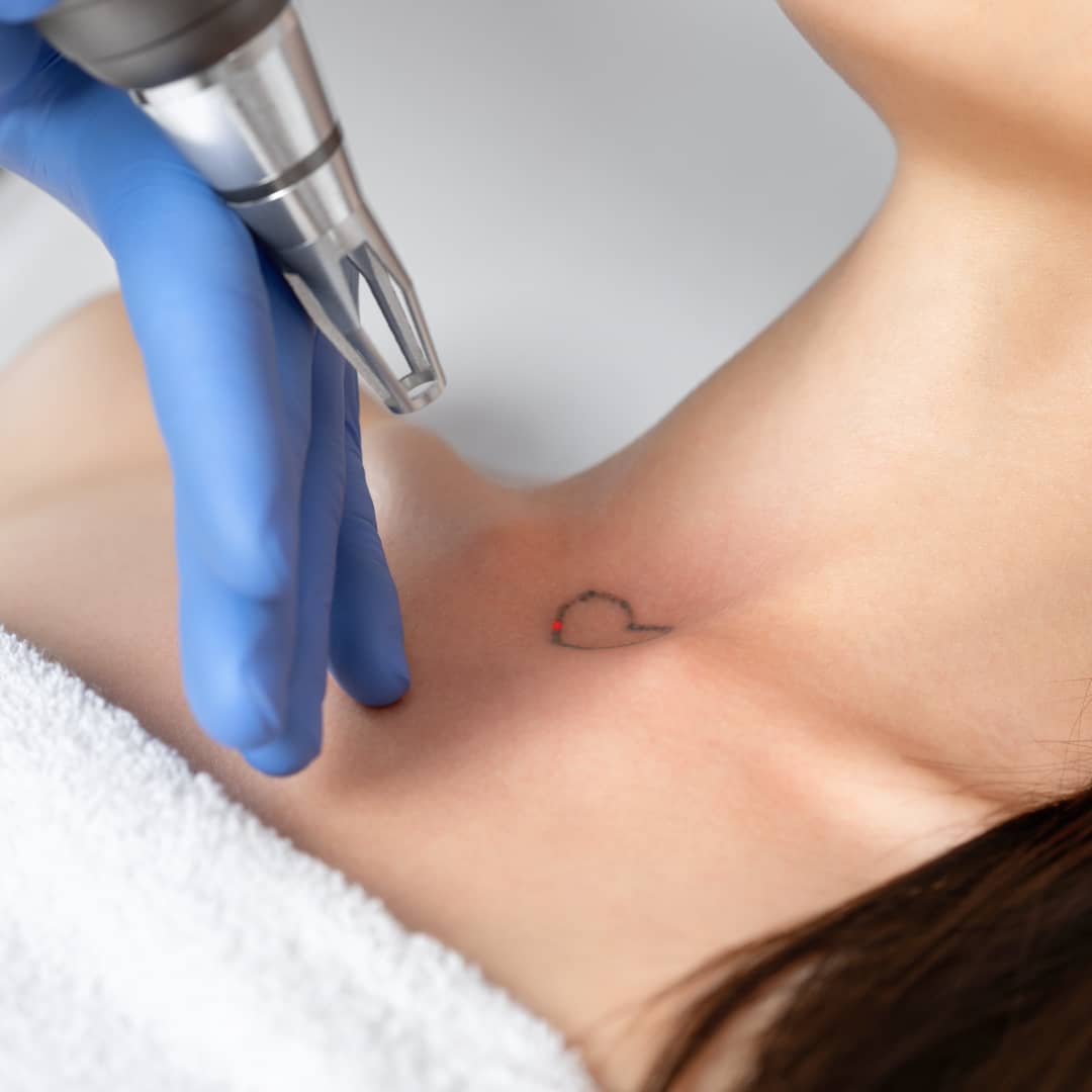 How does Tattoo Removal Works