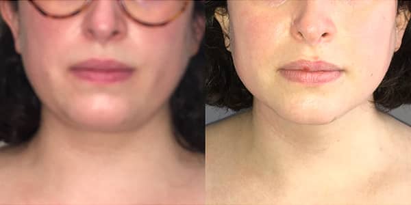 Chin Liposuction