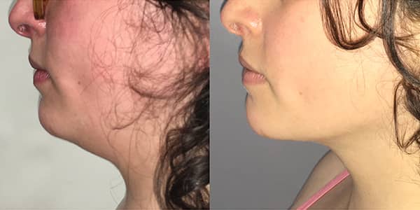 Chin Liposuction