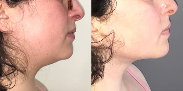 Chin Liposuction