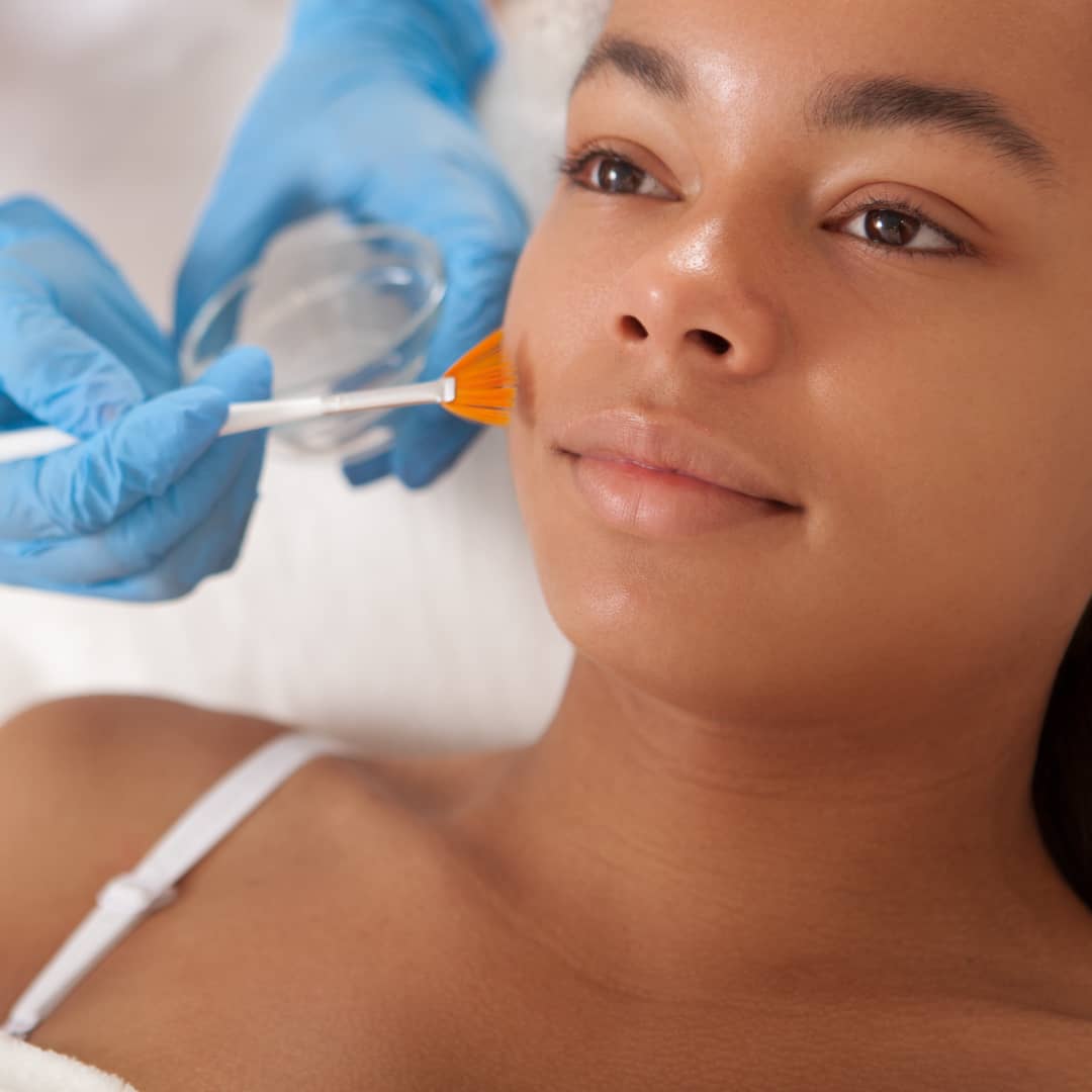 woman doing chemical peel for blackheads