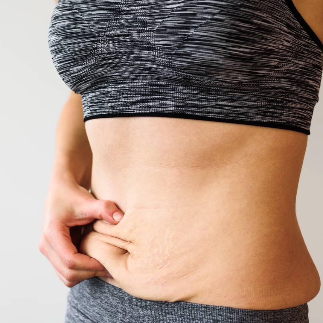 Thermage for loose skin