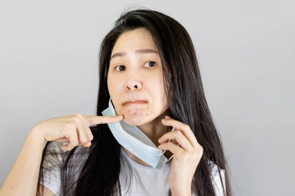 Treatment for Maskne