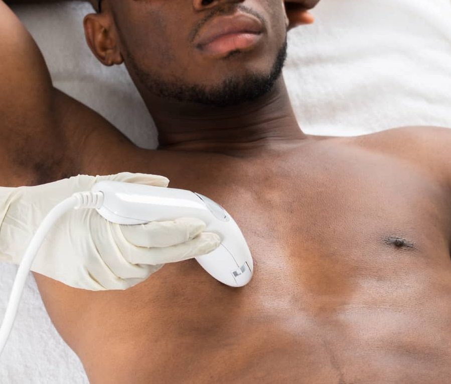 Laser Hair Removal for men