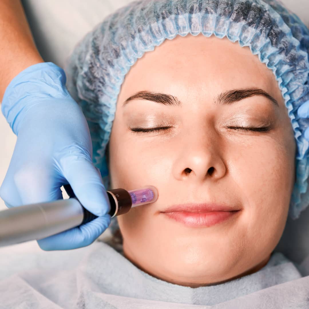 What to expect in a Microneedling Session