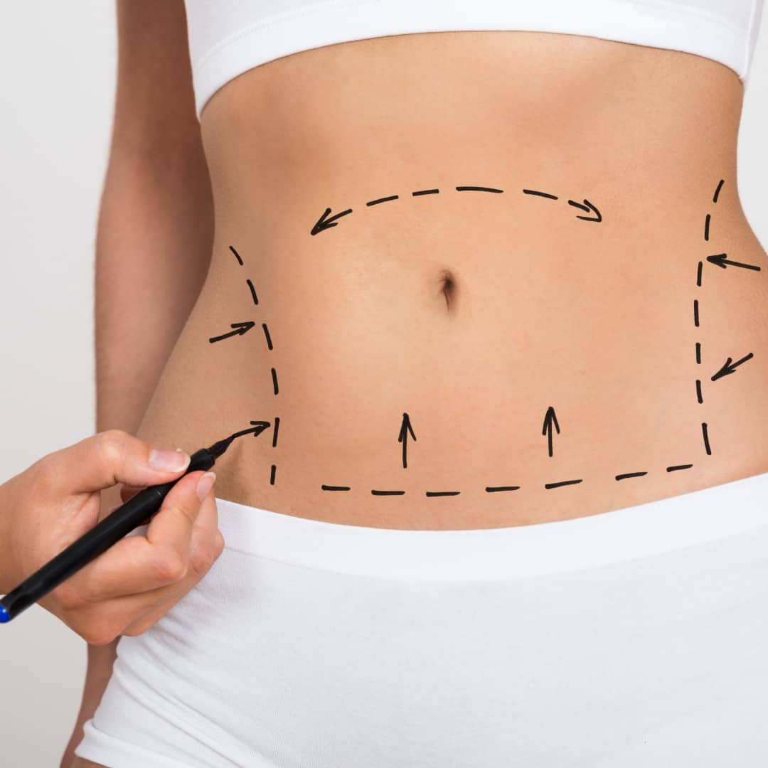 Liposuction London