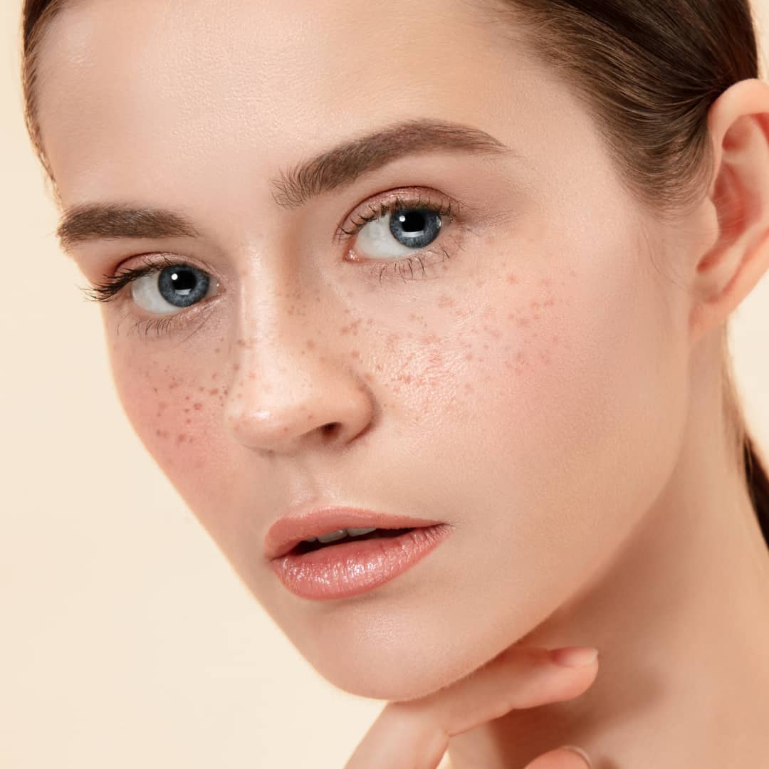 ClearLift for pigmentation