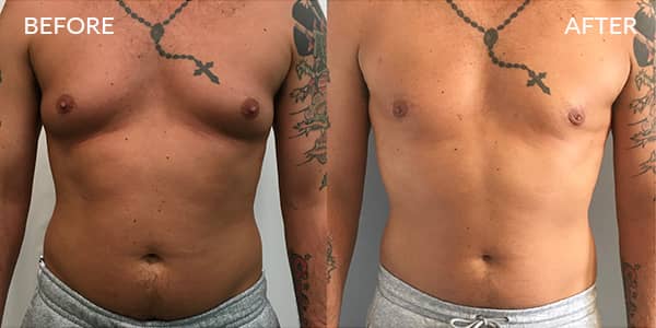 Male Chest Reduction - 001TPC-Side - The Private Clinic of Harley Street  London