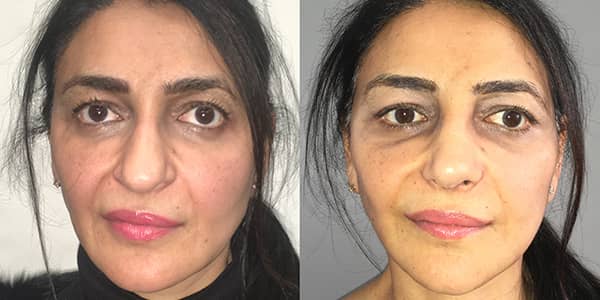 Facelift London Plastic Surgeon