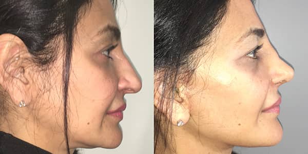 Facelift London Plastic Surgeon