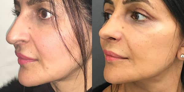 Facelift London Plastic Surgeon