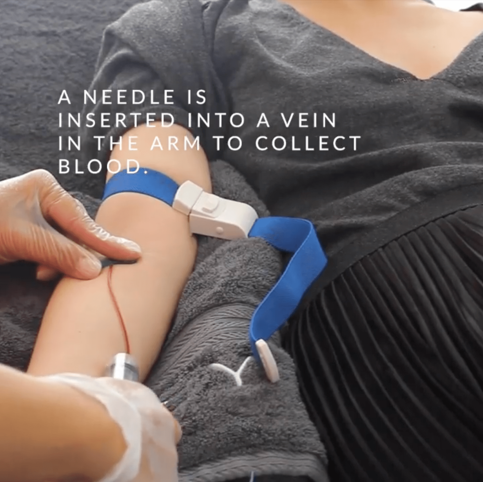 PRP Vampire Facial London 111 Harley St