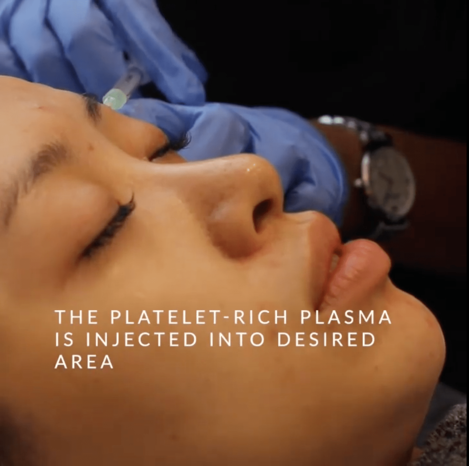 PRP Vampire Facial London