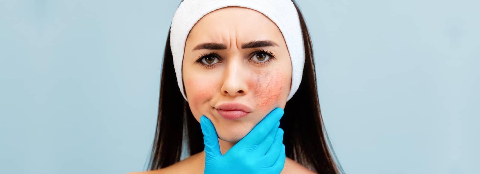 How to Treat Rosacea