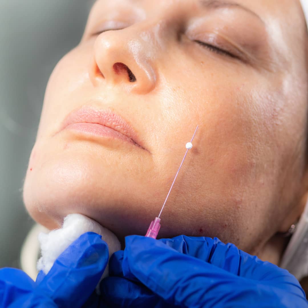 Benefits of PDO threads lift