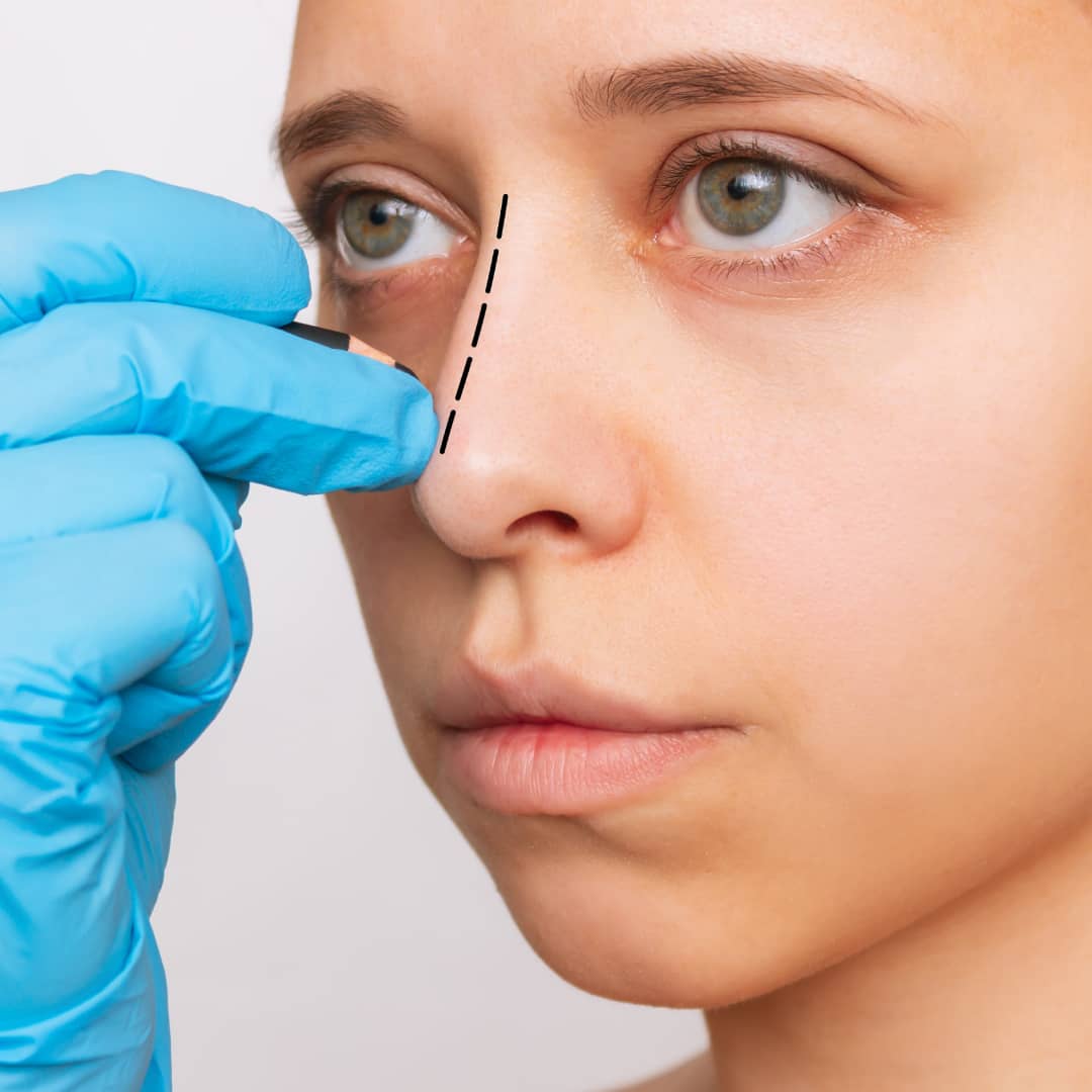 non-surgical-rhinoplasty-london