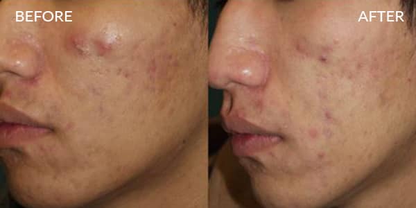 Potenza RF Microneedling For Acne