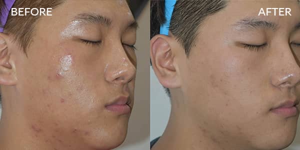 Potenza-RF-Microneedling-Acne-Before-and-after-13