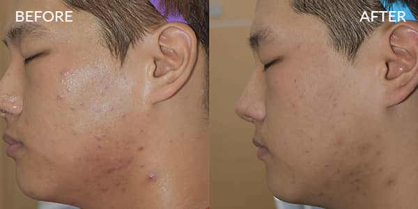 Potenza RF Microneedling For Acne