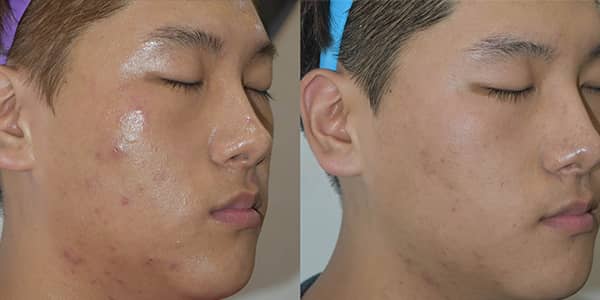 Potenza RF Microneedling For Acne