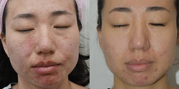 Potenza RF Microneedling for Acne