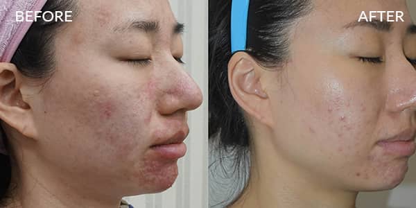 Potenza RF Microneedling for Acne