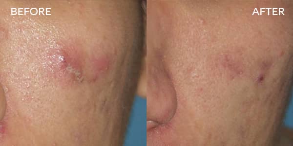 Potenza RF Microneedling for Acne