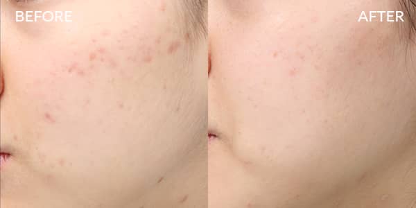 Potenza RF Microneedling for Acne Scarring