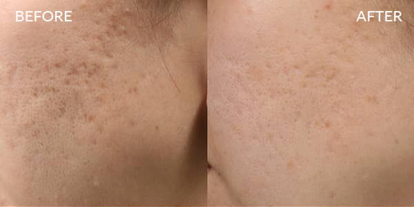 Potenza RF Microneedling for Acne Scarring