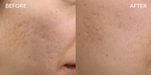 Potenza RF Microneedling for Acne Scarring