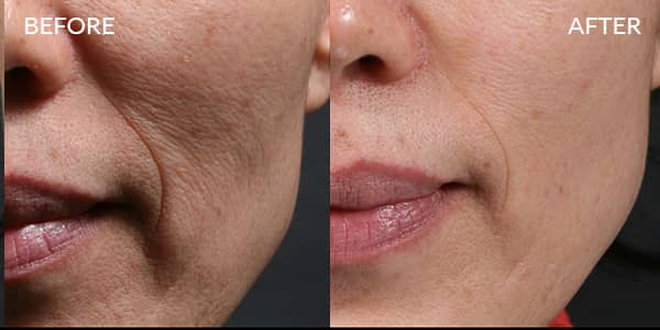 Potenza RF Microneedling for Wrinkles